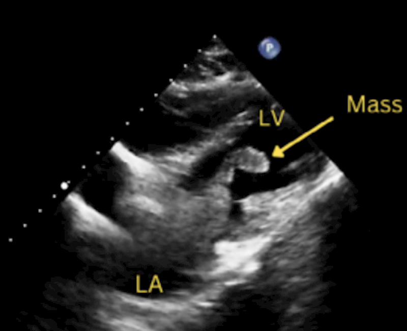 Simultaneous bilateral pulmonary and cardiac invasion of metastatic testicular germ cell tumor